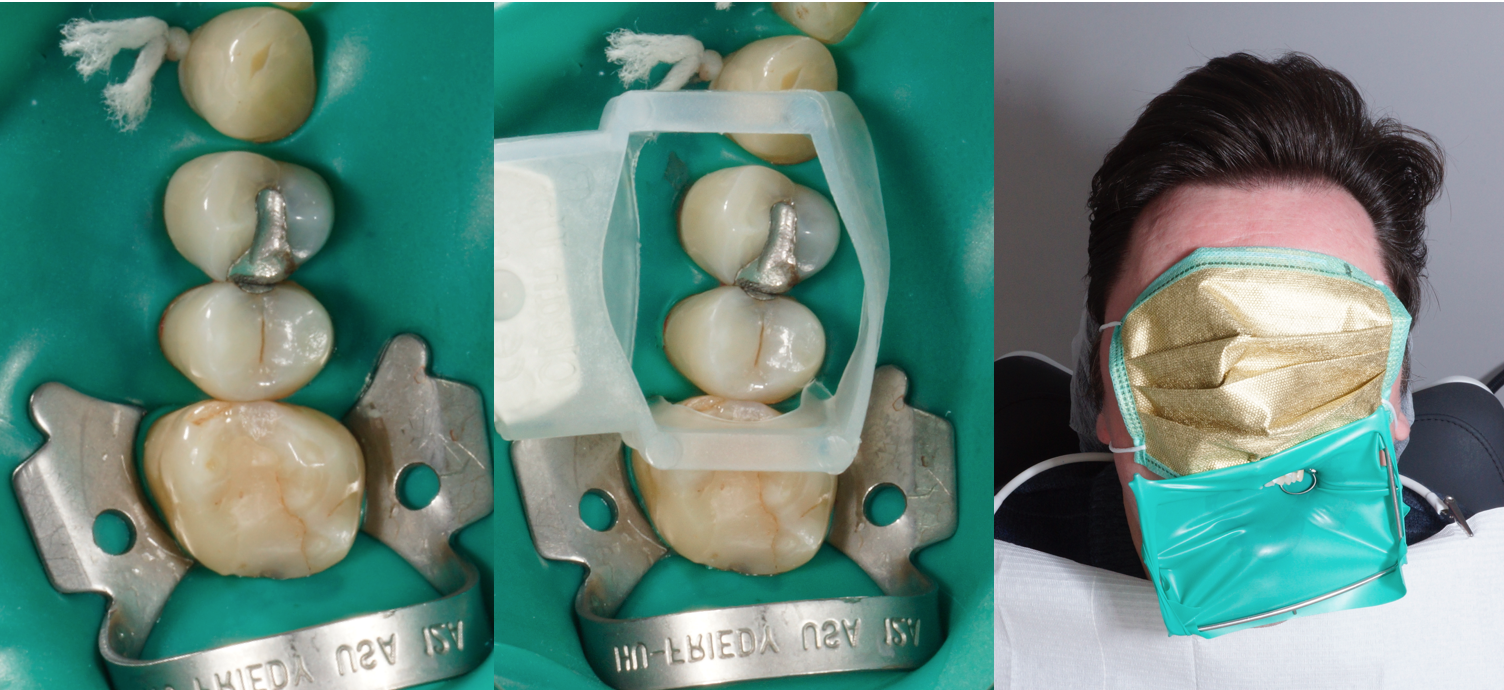 Amalgamentfernung Schutzmaßnahmen Dr. Riemann