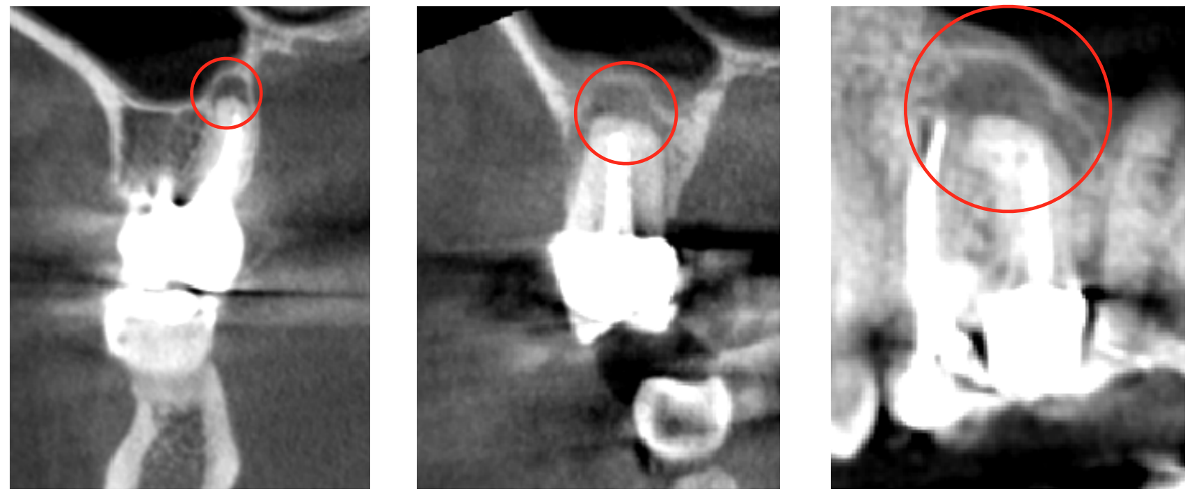 Entzündliche Veränderungen an den Wurzelspitzen von wurzelkanalbehandelten Zähnen