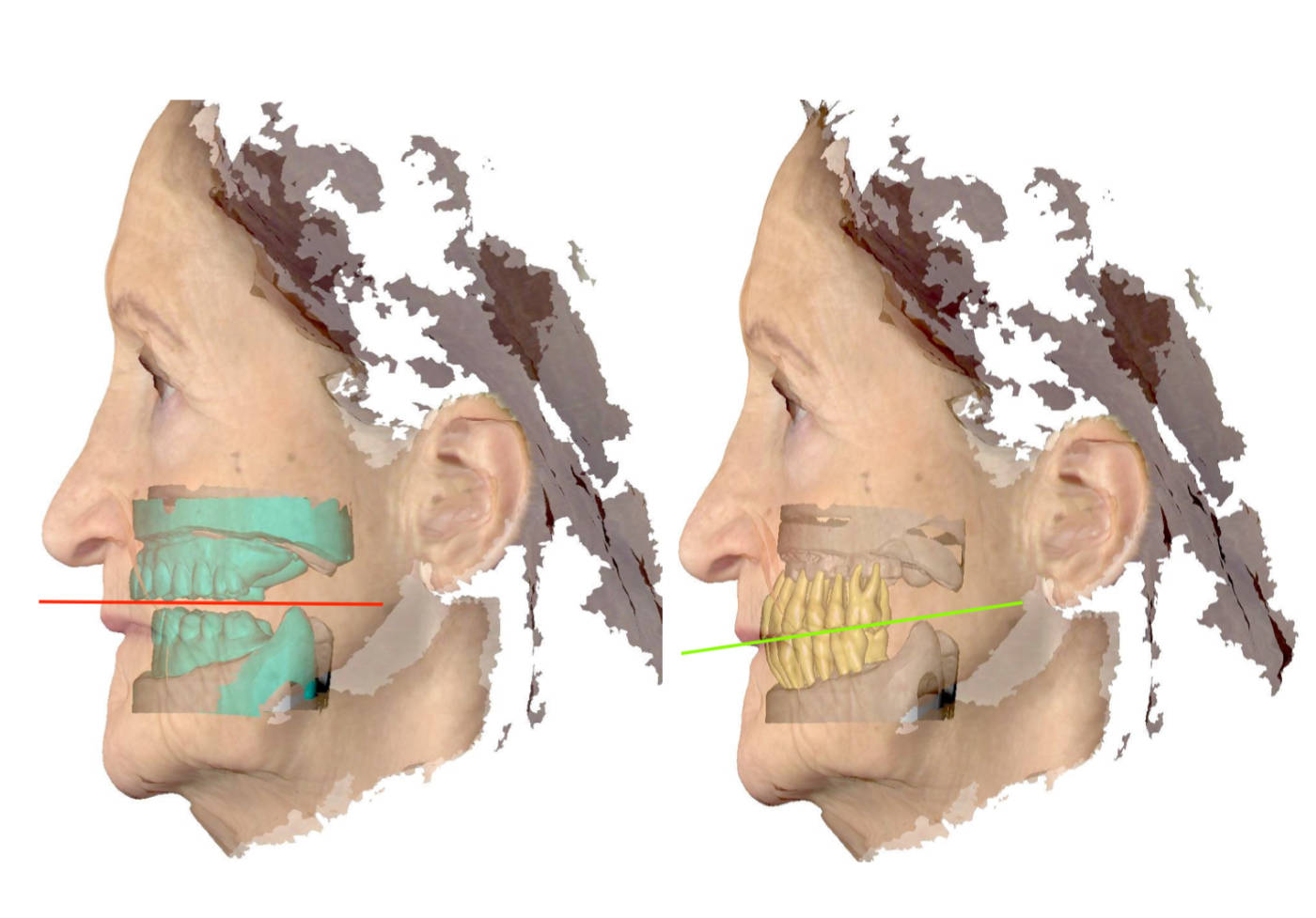 digitale Auswertung: links: falsche Ebene, rechts: richtige Ebene