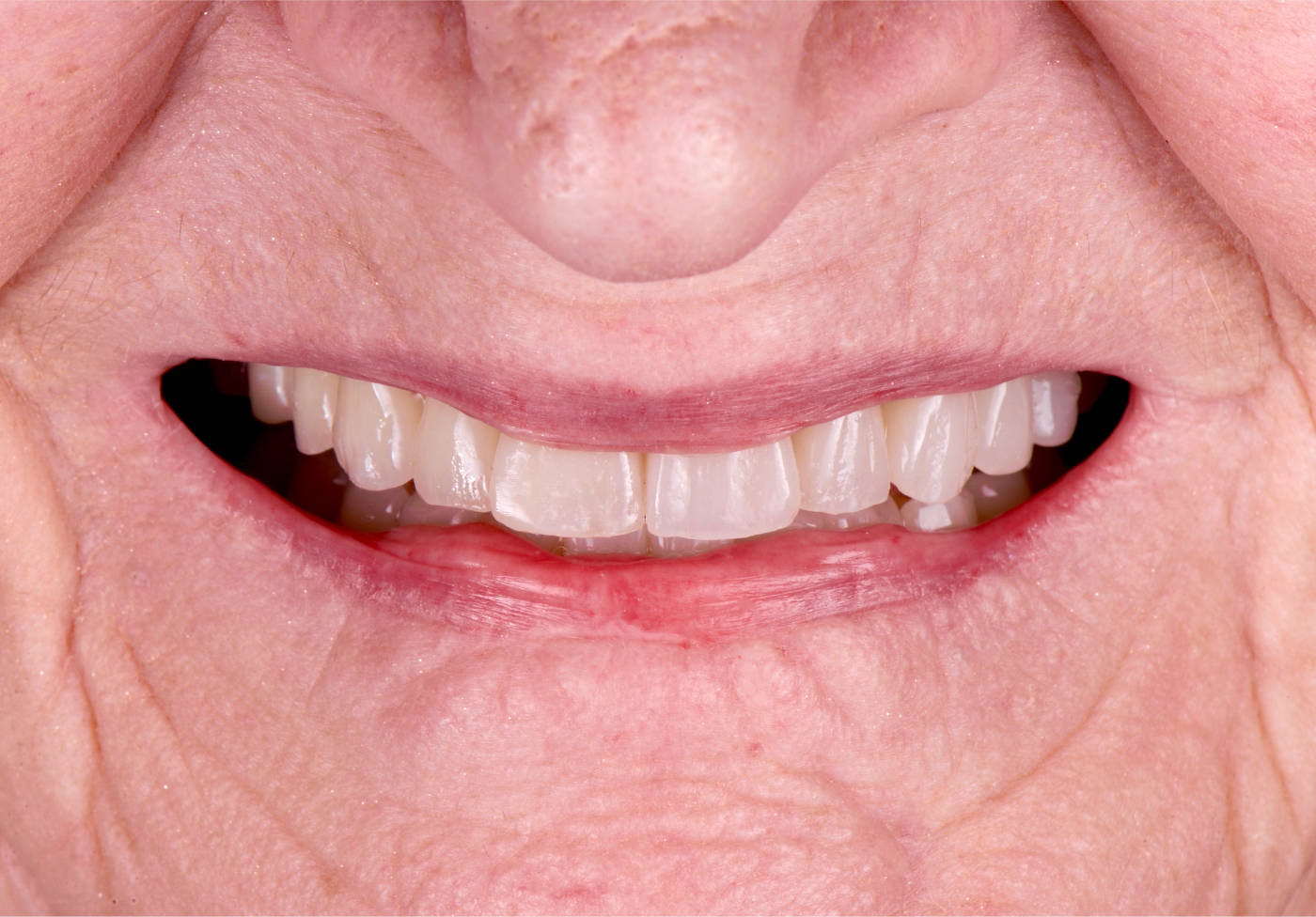 Behandlungsergebnis, perfekte Lippenunterstützung und Ästhetik der Frontzähne