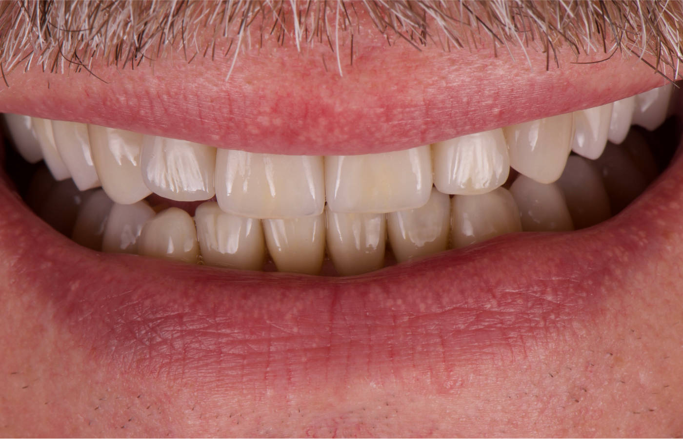 Finale, neue Zähne in Vollkeramik, Ober- und Unterkiefer