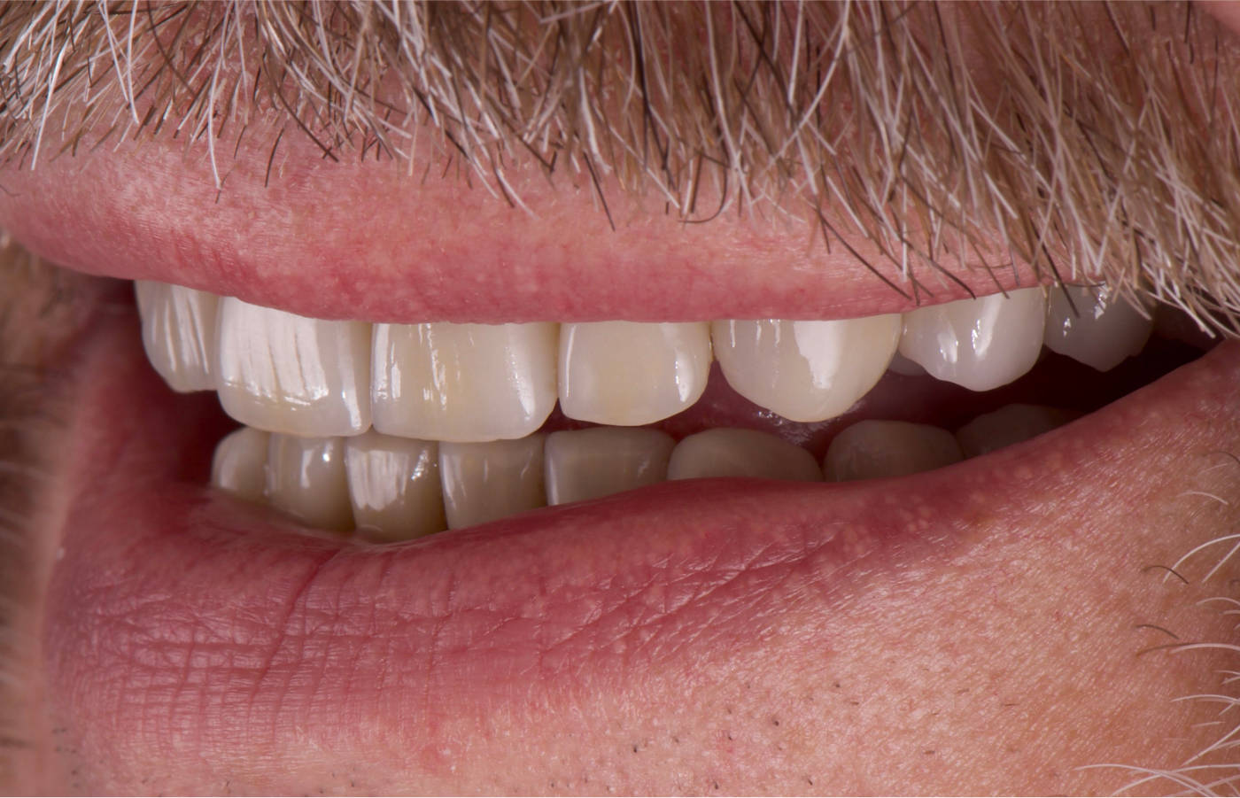 Finale, neue Zähne in Vollkeramik, Ober- und Unterkiefer