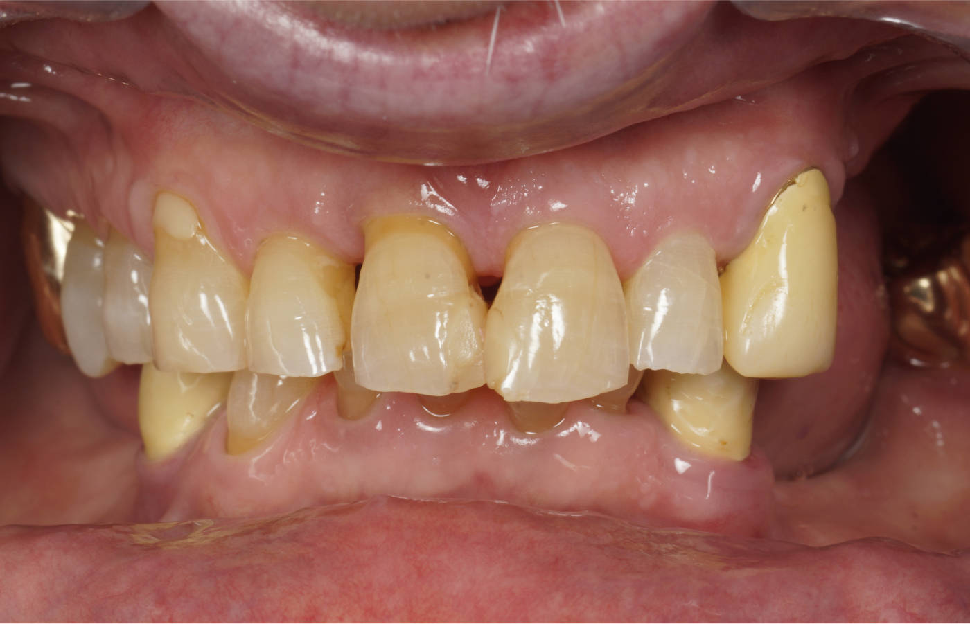 Ausgangssituation, o. herausnehmbarem Zahnersatz