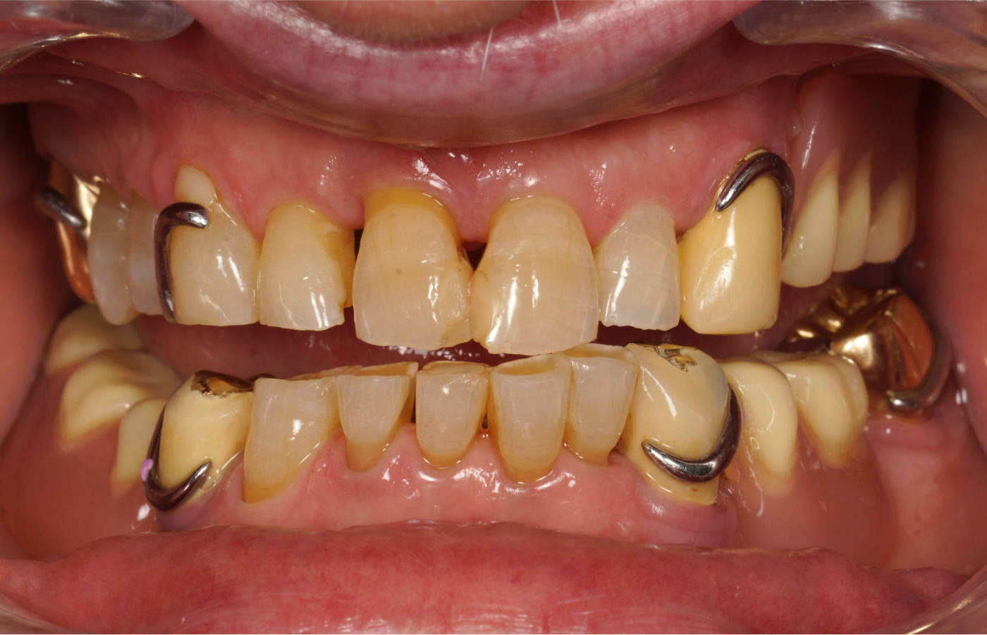 Ausgangssituation, mit herausnehmarem Zahnersatz