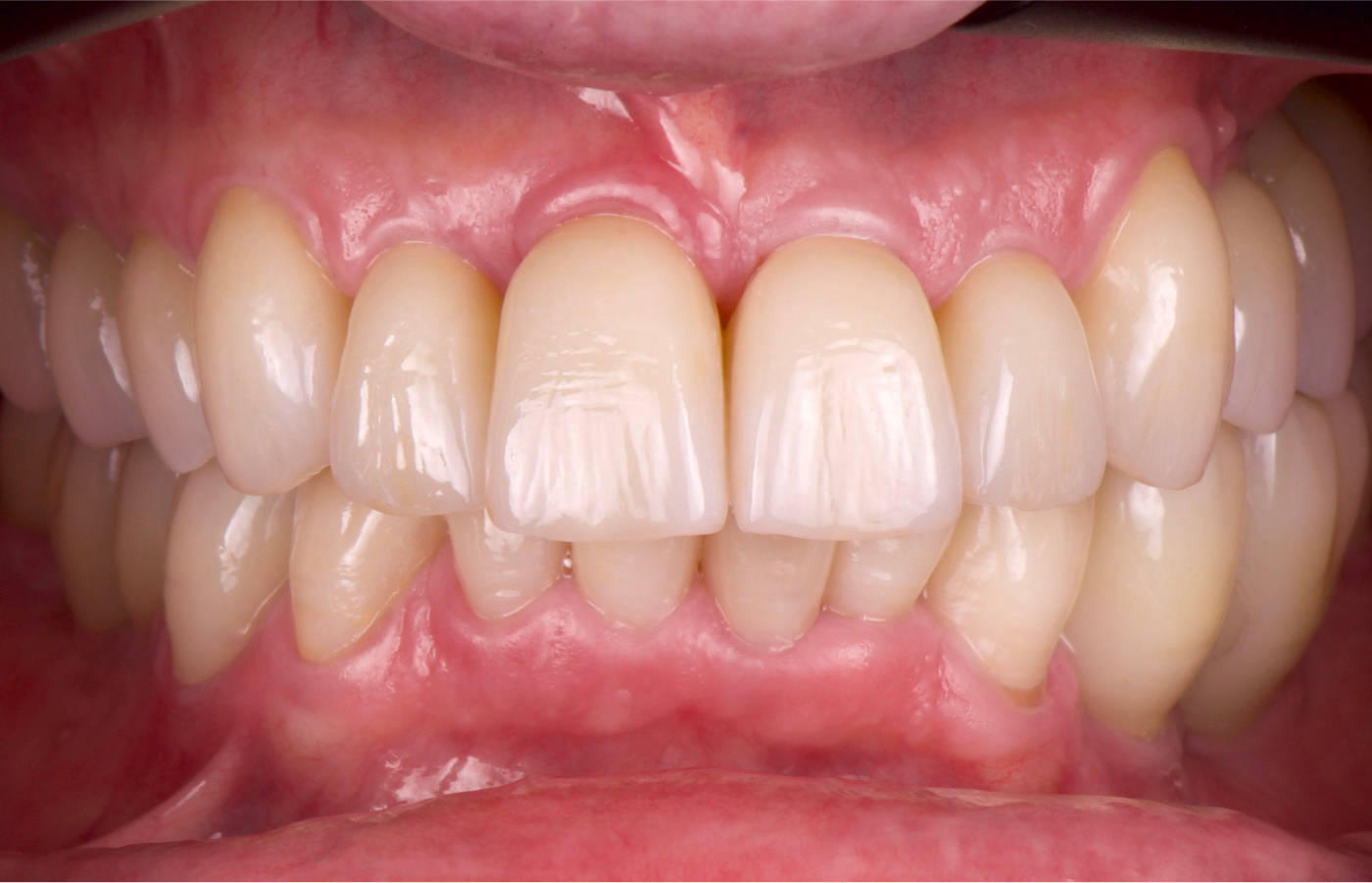 Finale, neue Zähne auf eigenen Zähnen und Implantaten aus Vollkeramik