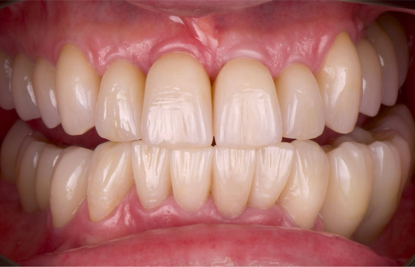 Finale, neue Zähne auf eigenen Zähnen und Implantaten aus Vollkeramik