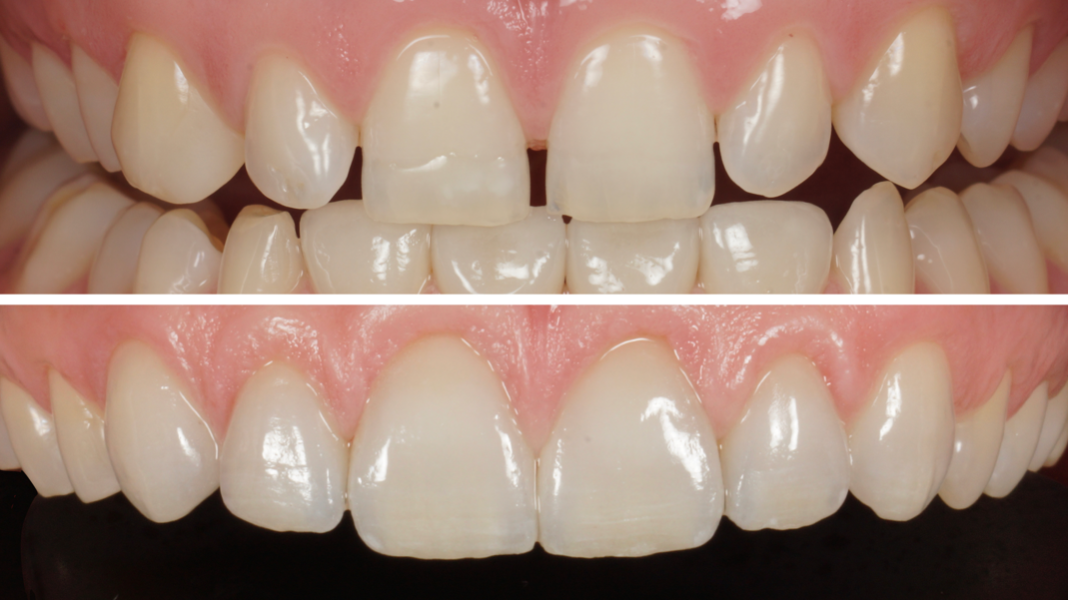 Veneer Beispiel Zahnarzt Nürnberg