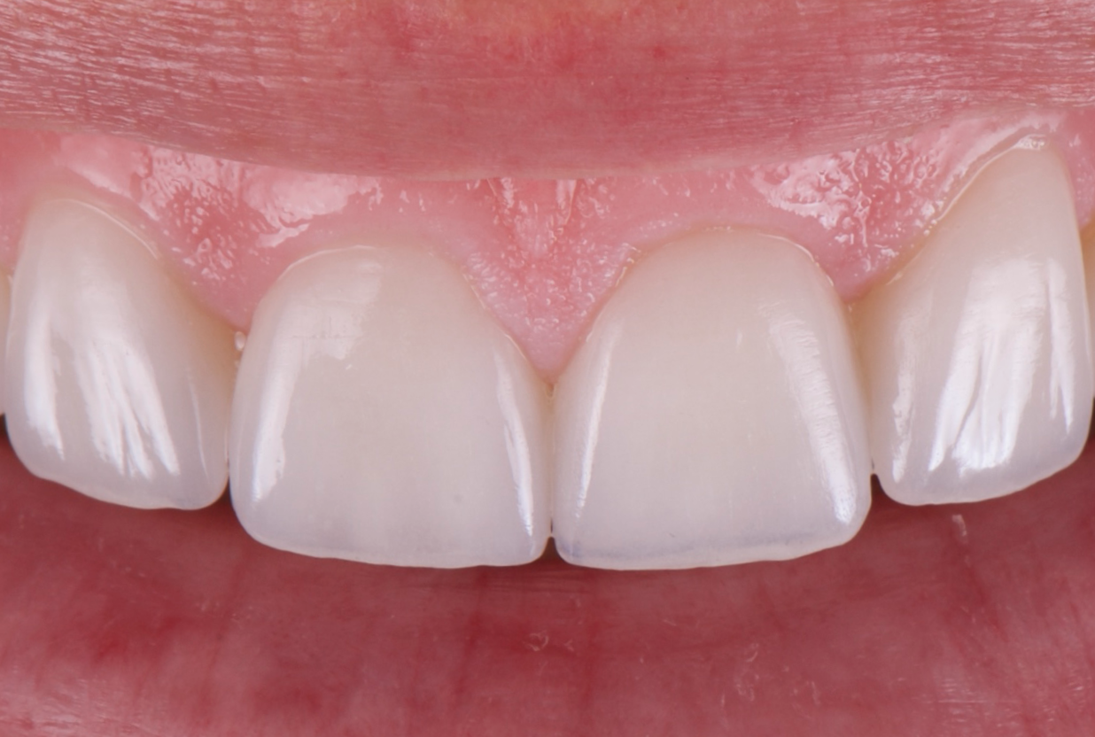 Veneers_Nuernberg_Symmetrie_Zahnarzt_Nuuernberg_Riemann