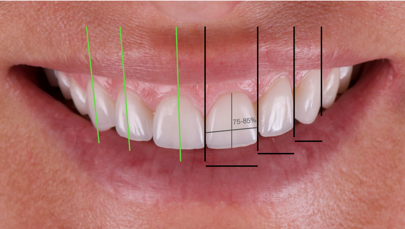 Veneers_Nuernberg_weiße_Aesthetik_Zahnarzt_Nuernberg_Riemann