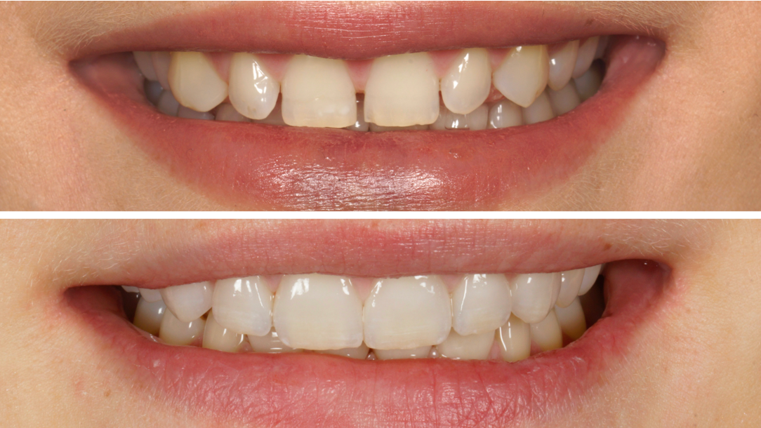 Veneers Beispiel Zahnarzt Nürnberg