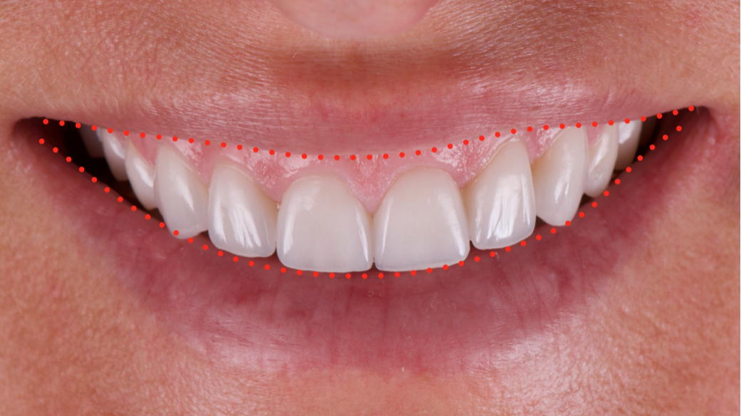 Veneers_Nuernberg_Aesthetik_Zahnarzt_Nuernberg_Riemann