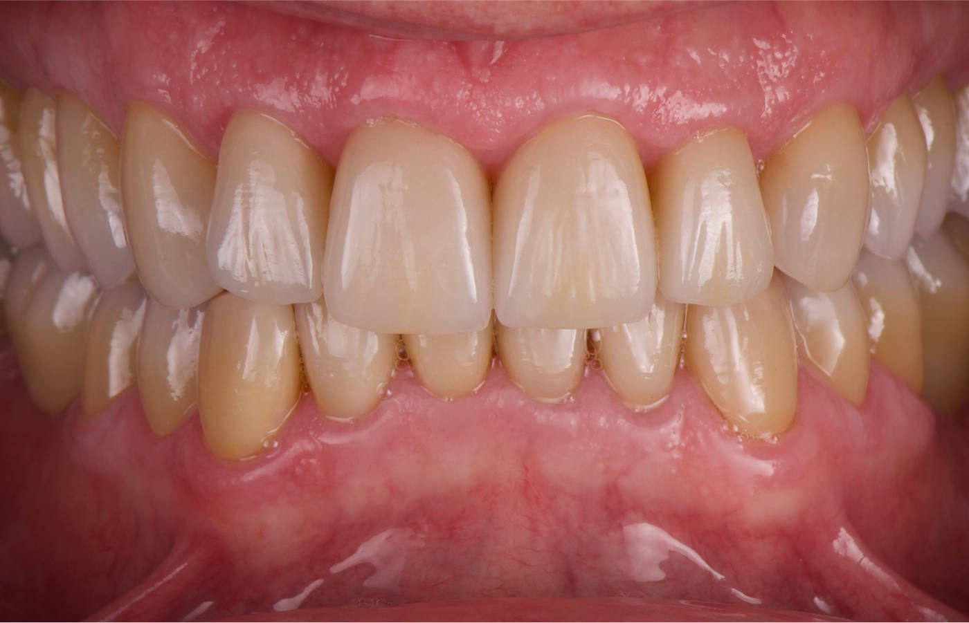 Finale, neue Zähne in Vollkeramik, Ober- und Unterkiefer