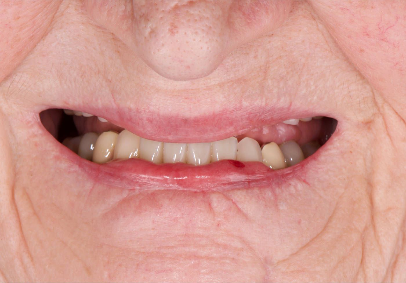 Ausgangssituation, falsche Ebenen der Zähne